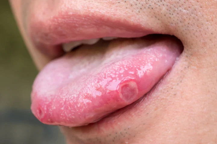 Canker Sore on Tongue